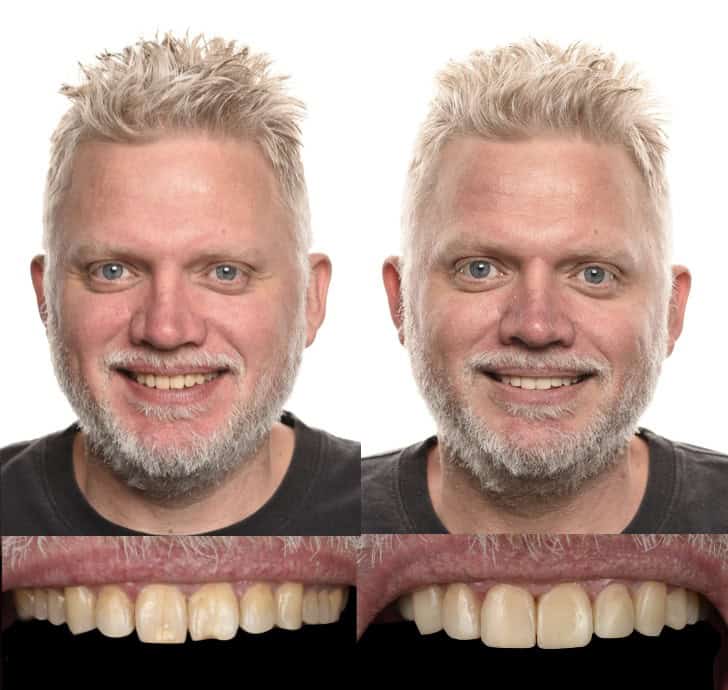 Smile alignment